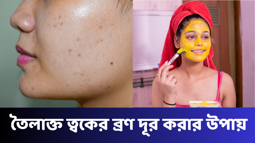 তৈলাক্ত ত্বকের ব্রণ দূর করার উপায়